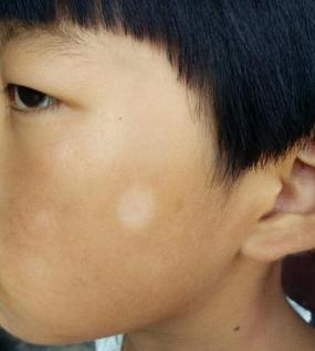 小孩被查出疑似白癜风,8岁孩子被确诊白癜风