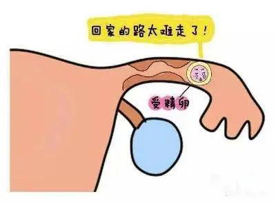 宫外孕微创手术多久可以试管婴儿,宫外孕后多久可以做试管