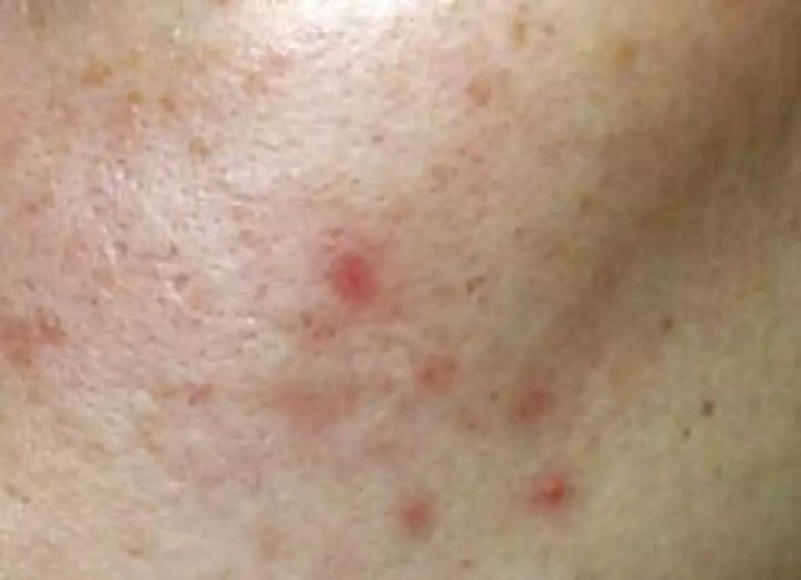 脸上痘印痘坑怎么消除最有效,痘坑怎么才能彻底解决