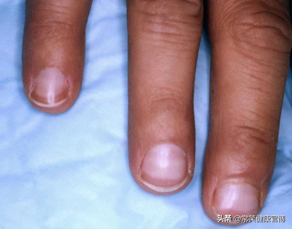 指甲出现各种问题的图片,指甲出现这些症状可能是灰指甲