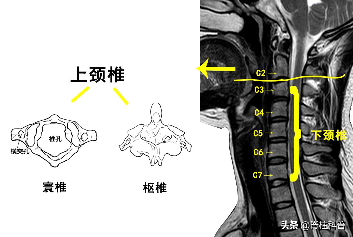逃过了医院手术的一劫,halovest支架