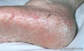 脚气皮肤科医生怎么说,皮肤科医生脚气小妙方