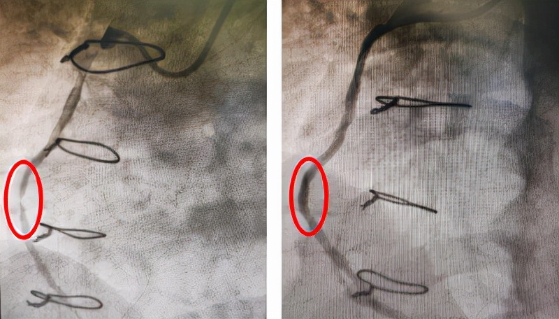 哈医大二院完成静脉桥血管再狭窄OCT指导下药物球囊介入治疗