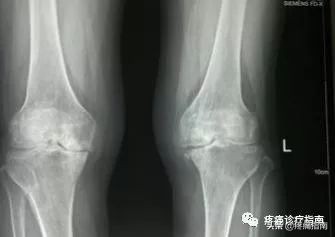 骨性关节炎诊疗指南2019解读,骨性关节炎的护理诊断和措施