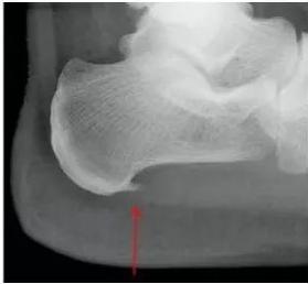 跟骨骨刺怎么办啊,右跟骨骨刺图片