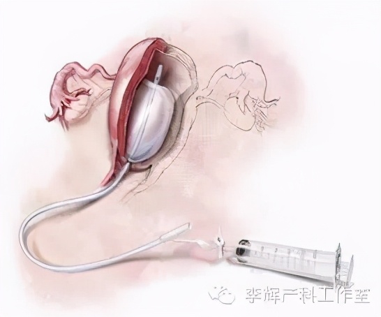 子宫收缩乏力引起产后出血的综述,宫缩乏力性产后出血的诊治建议