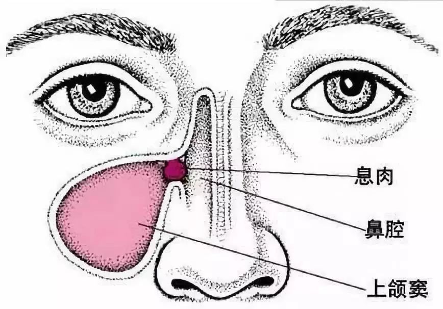 科普鼻息肉怎么形成的有什么危害,鼻息肉不治疗有什么危害