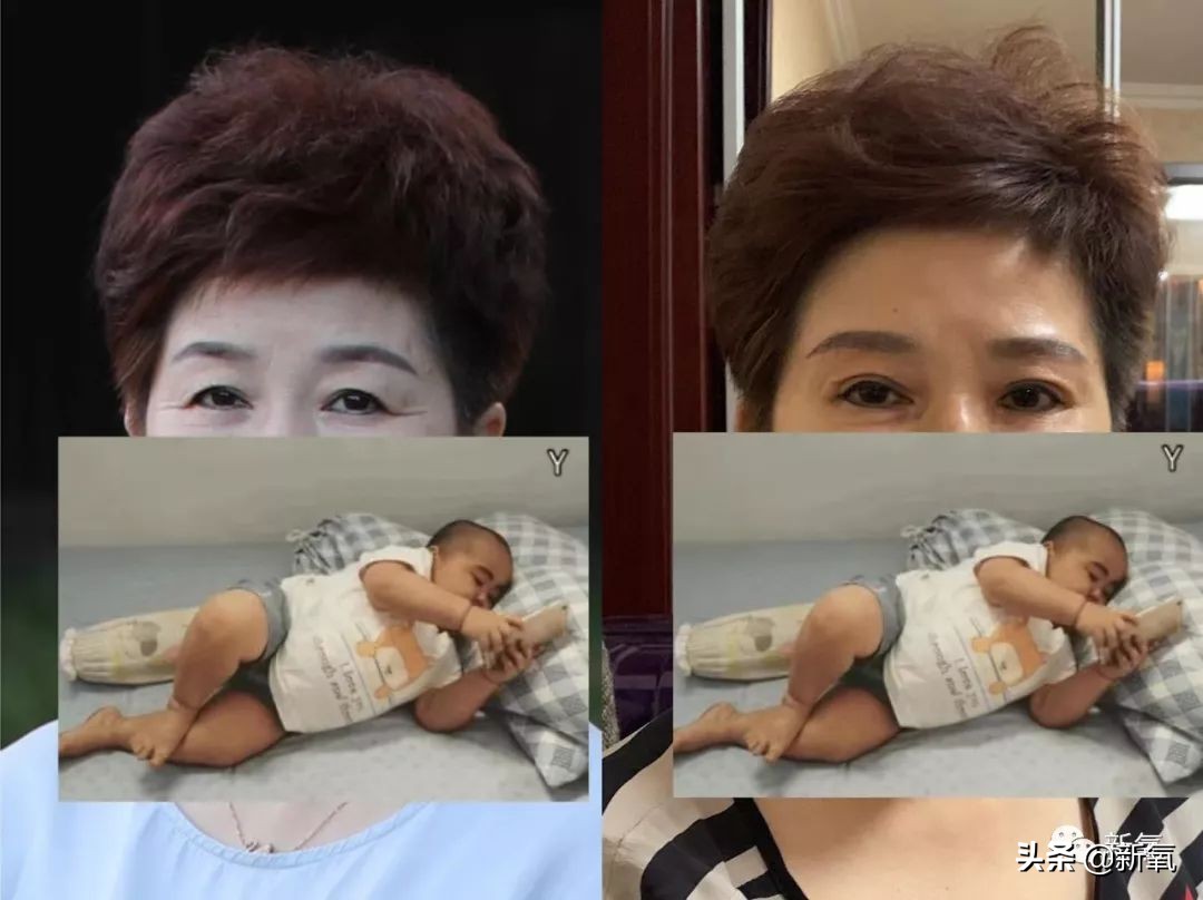 迷死氧亲身体验,我在日本吸掉了一桶脂肪和半张脸