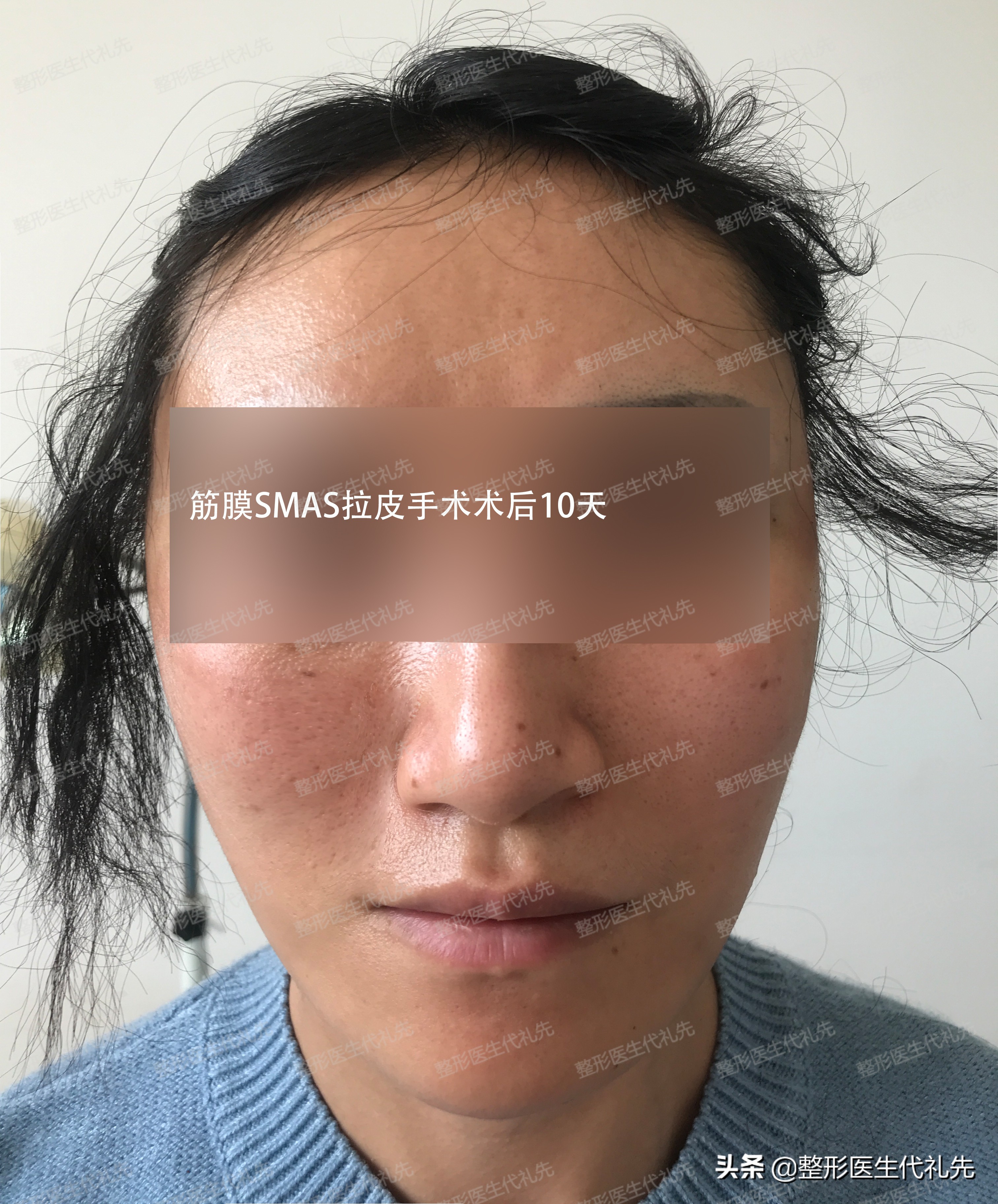 49岁女人做小拉皮术后恢复,50岁女人拉皮手术后脸变化