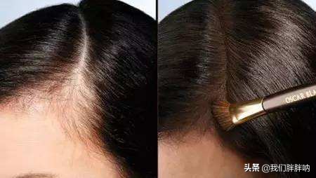 女生秃头的原因及治疗,女生为什么秃头怎么拯救