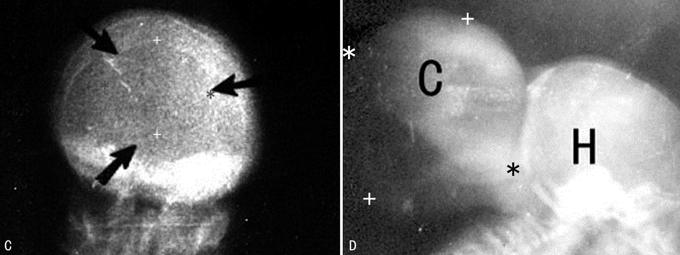 做普通彩超能不能看到胎儿侧脑室,超声胎儿针对性结构检查