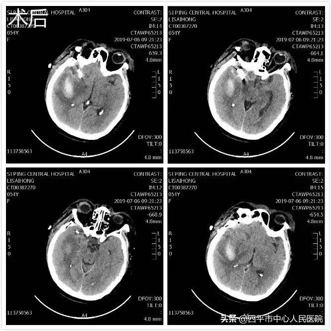 精准排雷再现新高—神经外科在6月份成功救治6例颅内动脉瘤患者