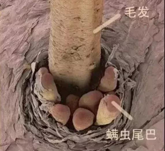 螨虫叮咬传播疾病,尘螨叮咬怎么治疗