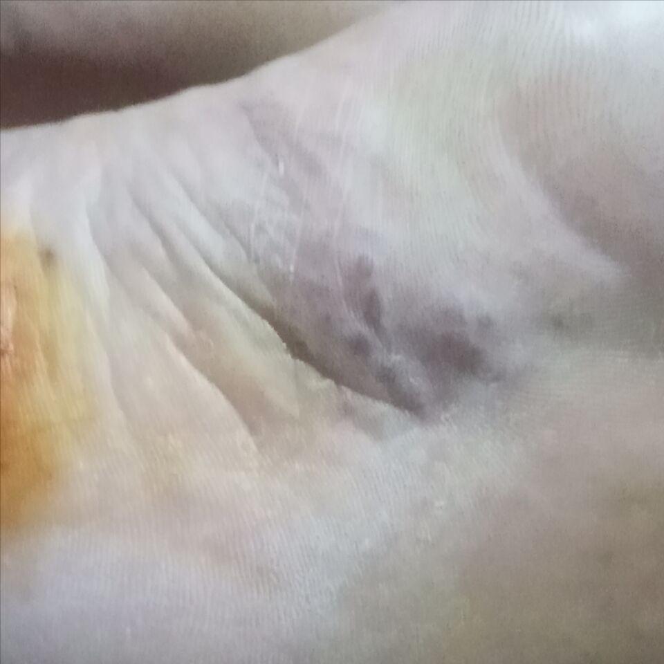 生殖器疱疹会误诊为带状疱疹吗,带状疱疹引起腰痛误诊分析