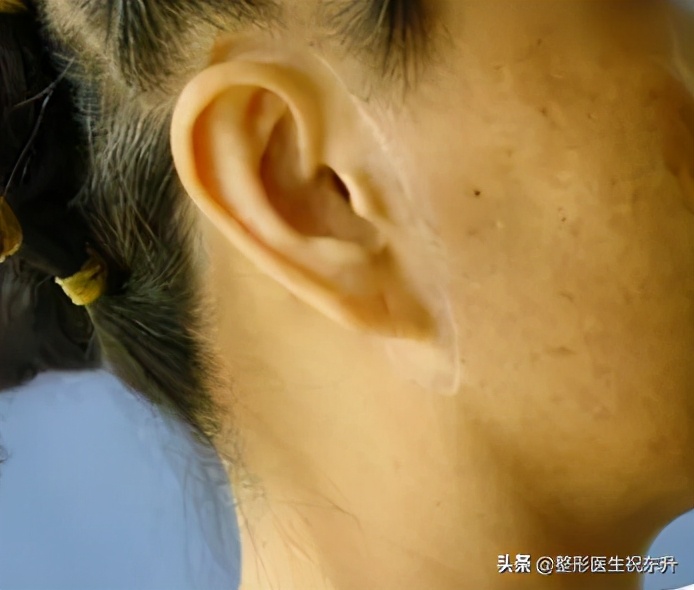 拉皮手术后必须用疤克吗,不做拉皮手术会留疤吗