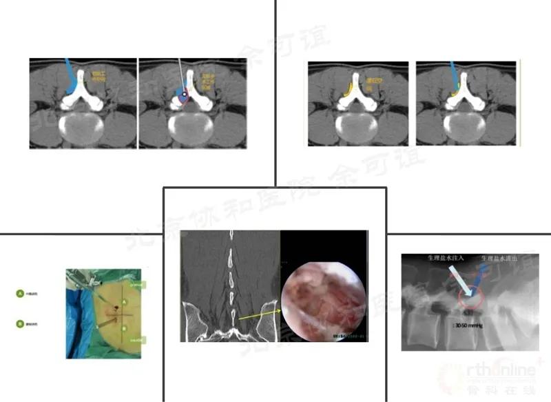 单侧双通道脊柱内镜技术优势,双通道脊柱内镜