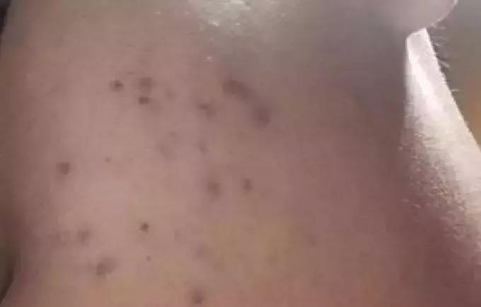 痘印根本治不住怎么办,痘印反反复复消不掉