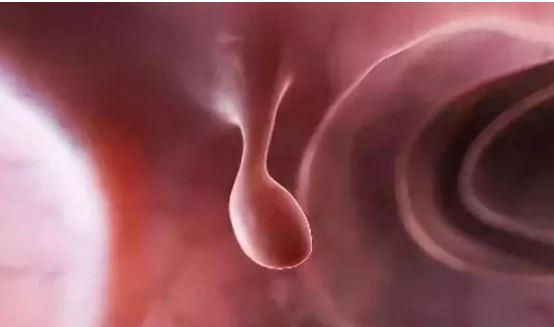 查出来有息肉需要直接做手术吗,查出息肉