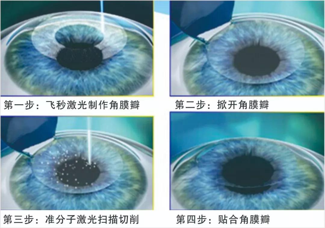 参军入伍眼睛视力需要多少,参军入伍视力4.2合格吗