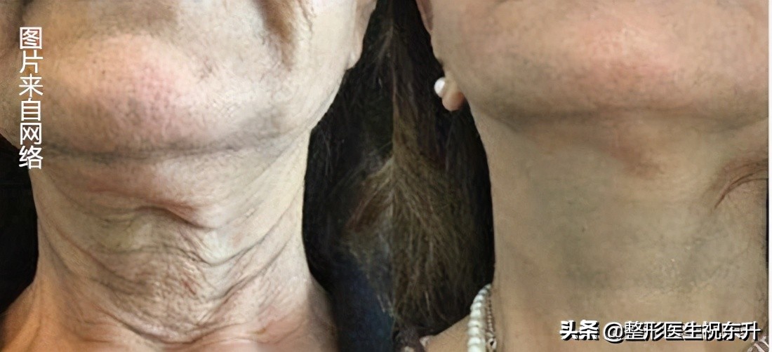 小女孩颈纹是怎么形成的,脖子上的颈纹是怎么形成的