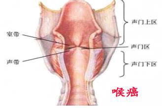 40岁男子确诊喉癌曾以为是咽炎,警惕慢性咽炎的误诊与认知误区