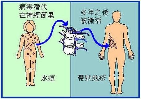 听说这种病，缠满身体一圈会死人？