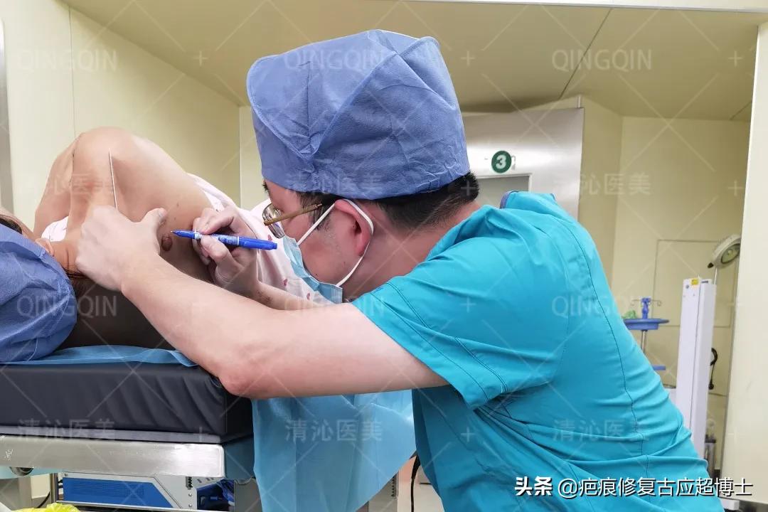 背部瘢痕疙瘩怎么去除,肩膀瘢痕疙瘩怎么食疗