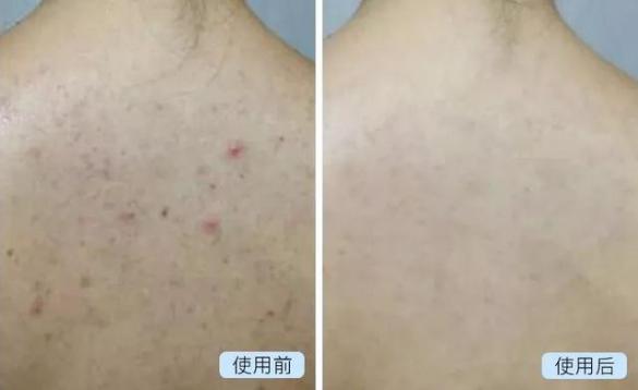 日本去螨虫皂,日本小黑皂号称螨虫克星