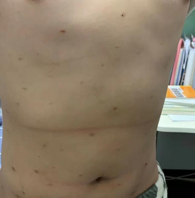 中医治疗皮肤痒的最好方法,中医治疗皮肤纤维瘤