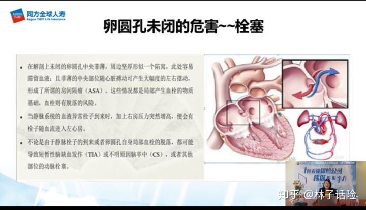 宝宝卵圆孔未闭合可以买保险吗,宝宝卵圆孔未闭可以买重疾险吗