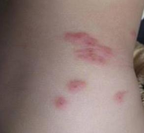 蚊虫叮咬后止痒的小妙招,蚊虫叮咬引起的湿疹怎么治疗