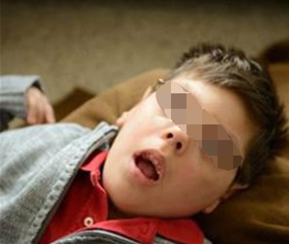 小儿癫痫会影响智力怎么办,小儿癫痫对智力有影响吗