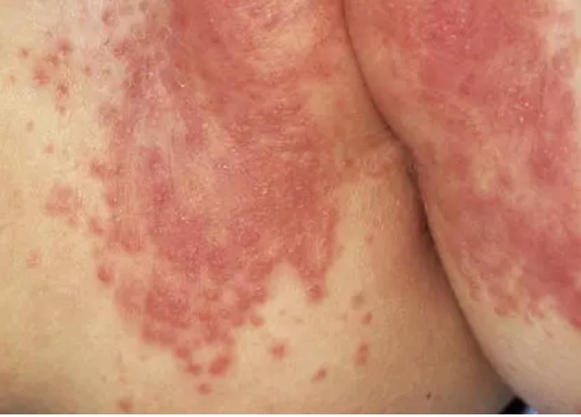 宝宝有红屁股，家长该如何治疗和预防？