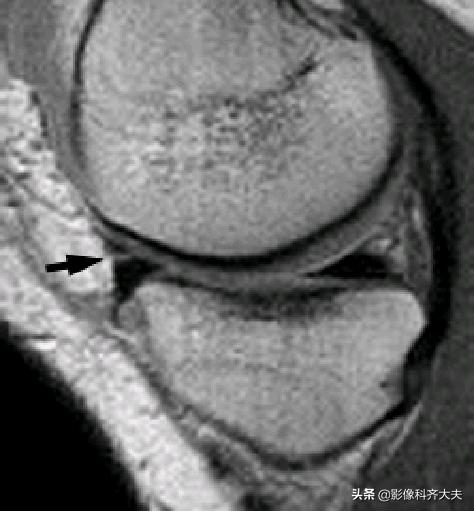 膝关节半月板损伤的磁共振,膝关节半月板病变的mri诊断与鉴别