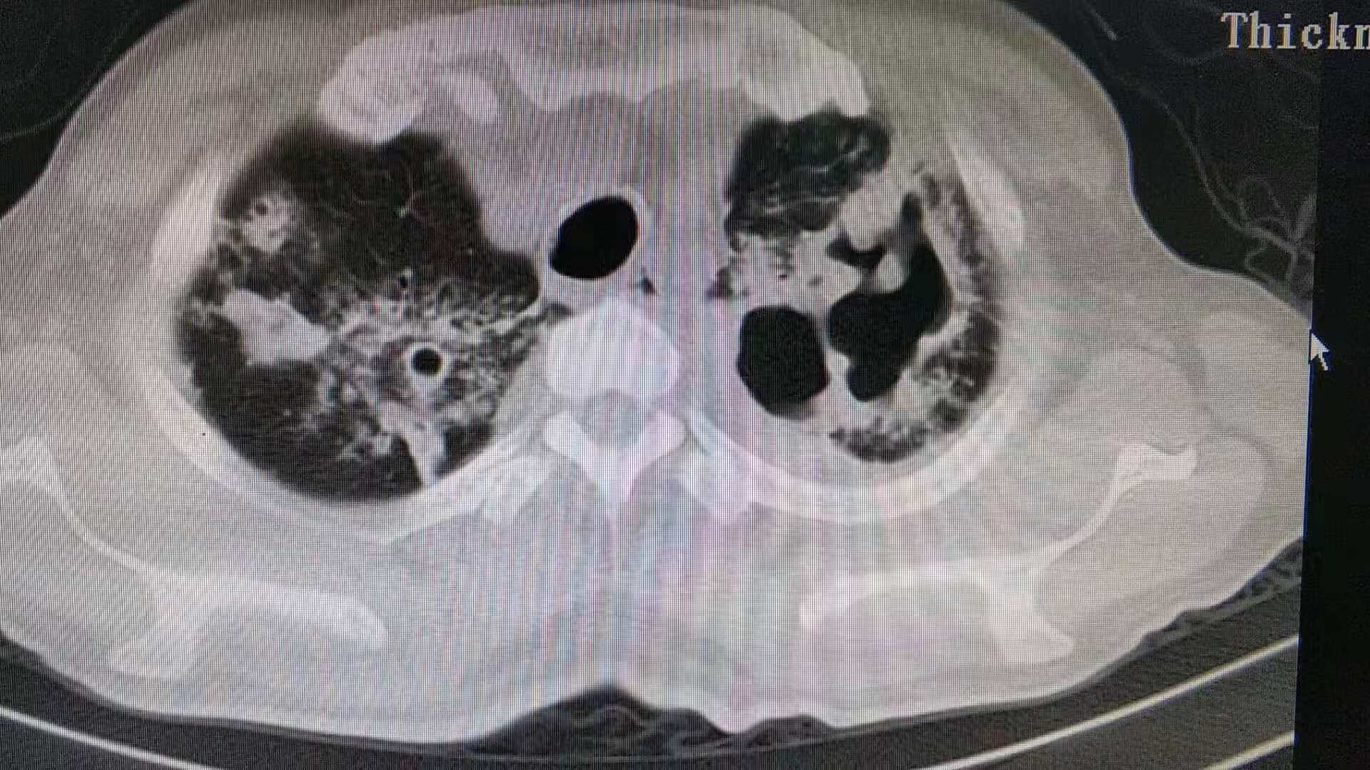 肺结核有哪些注意事项,肺结核有哪些注意的饮食