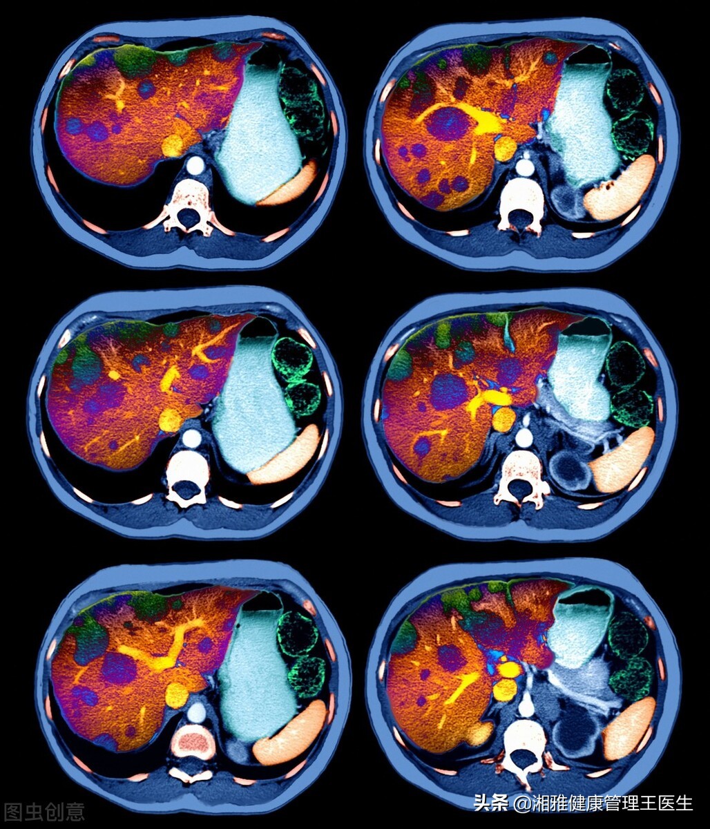 肝癌来临时会有这些表现，最好的措施就是这样治疗