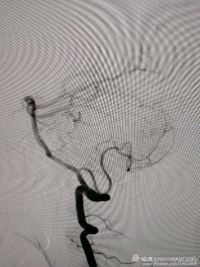 神经外科手术动脉瘤,湖南省人民医院脑动脉瘤介入治疗