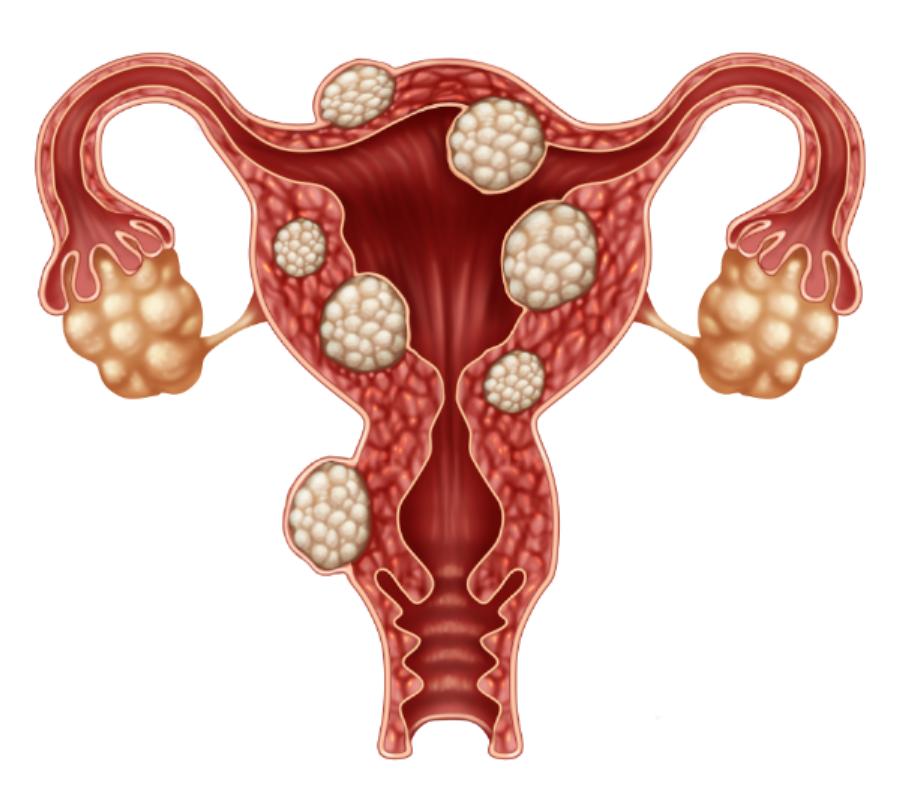 治疗子宫肌瘤最好的7个方法,子宫肌瘤应该怎么治疗比较有效