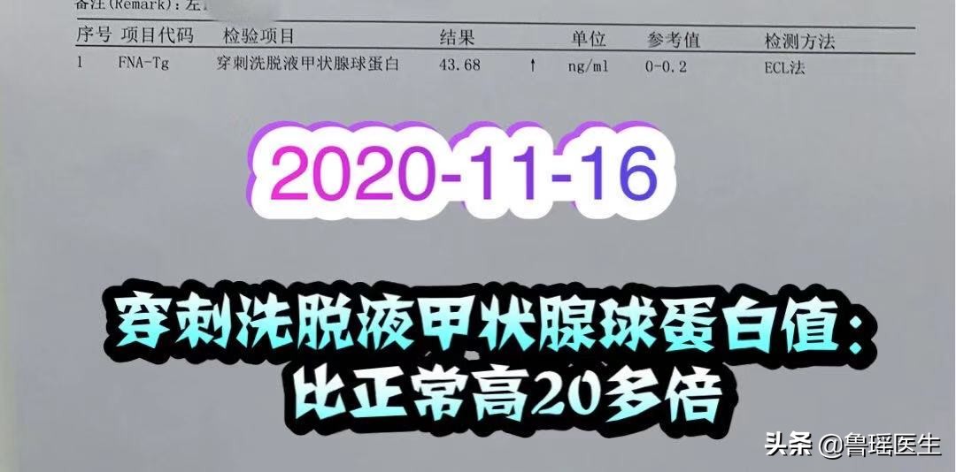 一侧甲状腺微小癌行手术治疗,是“过度治疗”吗?