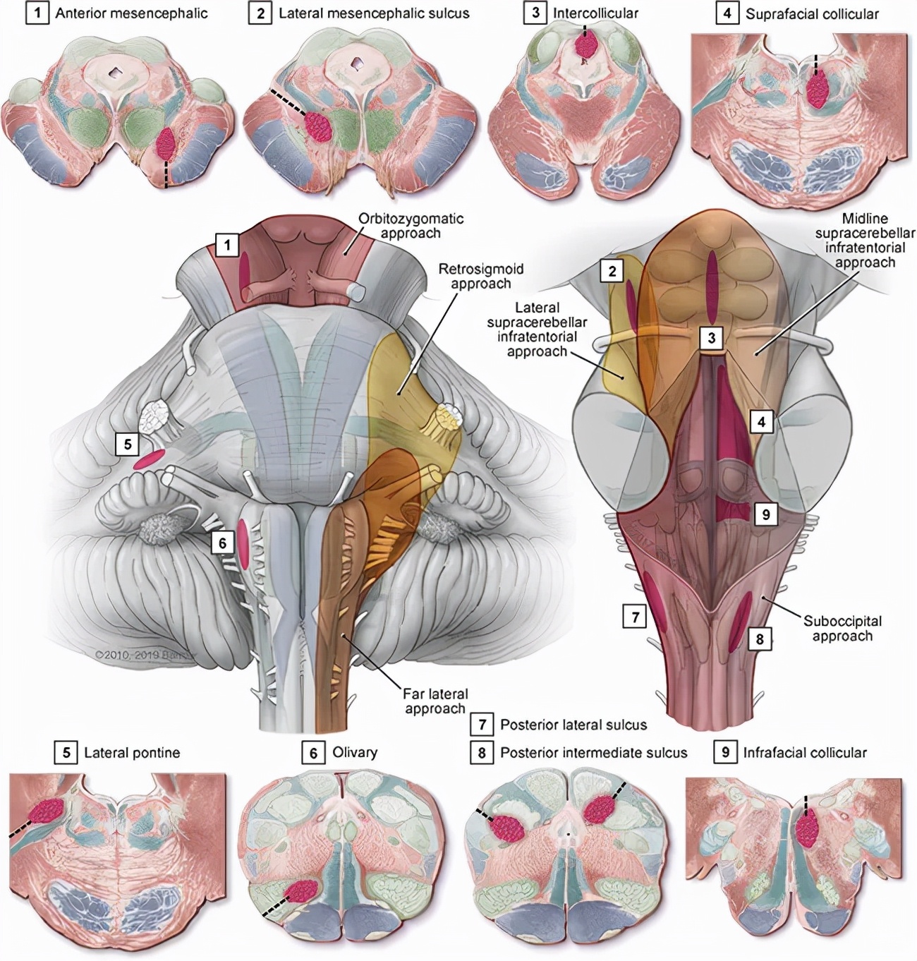 颅内海绵状血管瘤能治好吗,什么是颅内海绵状血管瘤