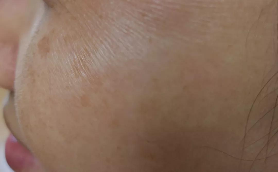 祛斑内调好还是外用好,冬季祛斑正确用法