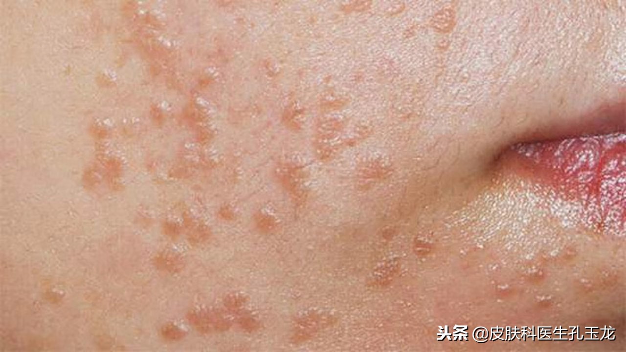 皮肤科疣状症怎么治,皮肤科医院如何治扁平疣