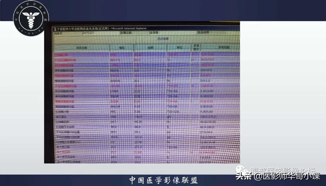 [精品课件]畸胎瘤及精原细胞瘤（*丸睾**肿瘤及肿瘤样变CT及MR表现）