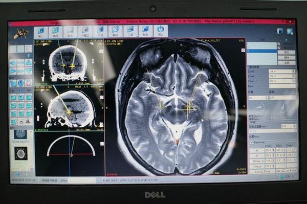 国外先进神经外科手术,神经外科手术真实案例