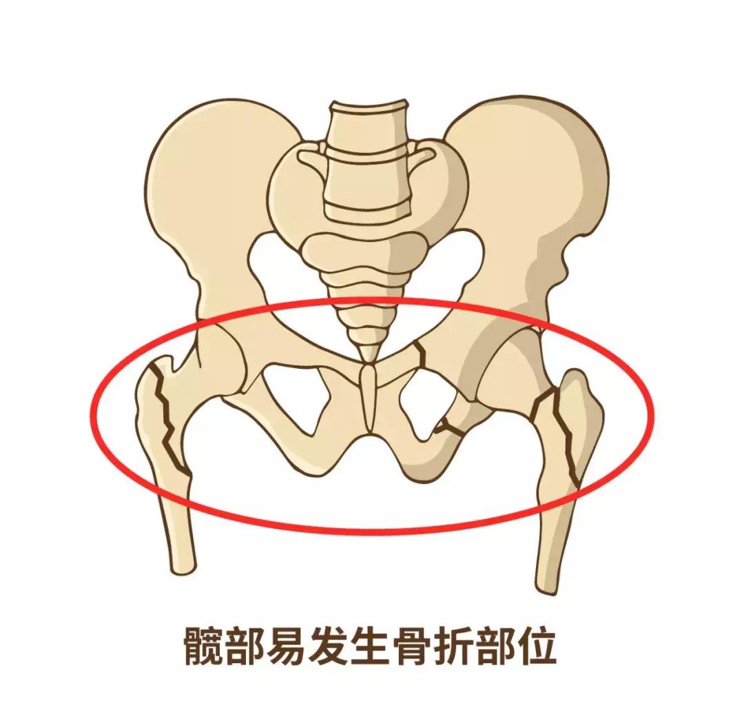 摔跤会死人吗,老年人为什么摔跤致命