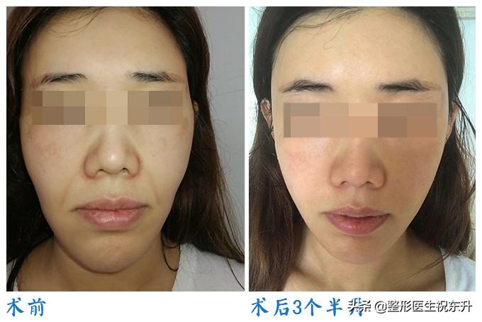 想要摆脱法令纹方法,告别法令纹最好的方法