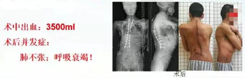 成人脊柱畸形矫形策略是什么,脊柱畸形医疗救治