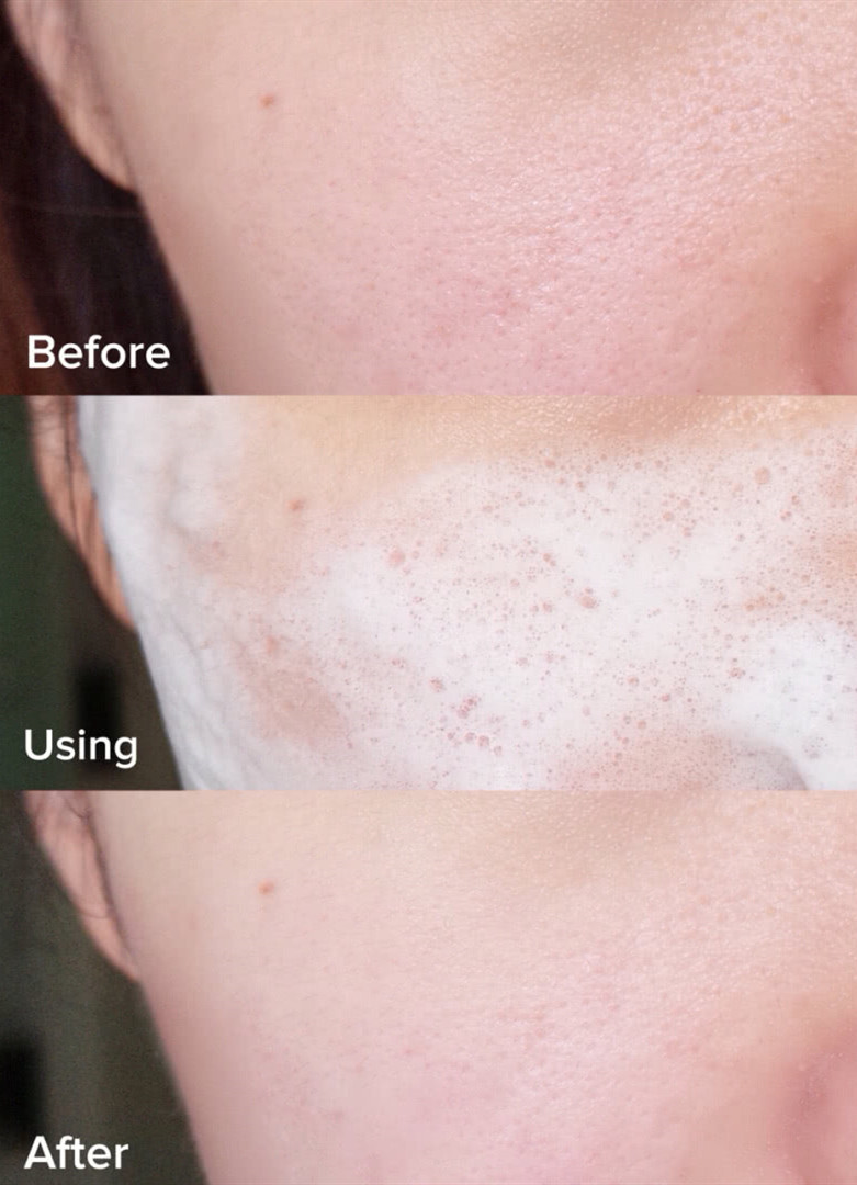 螨虫长痘快速解决办法,好物推荐护肤去螨虫