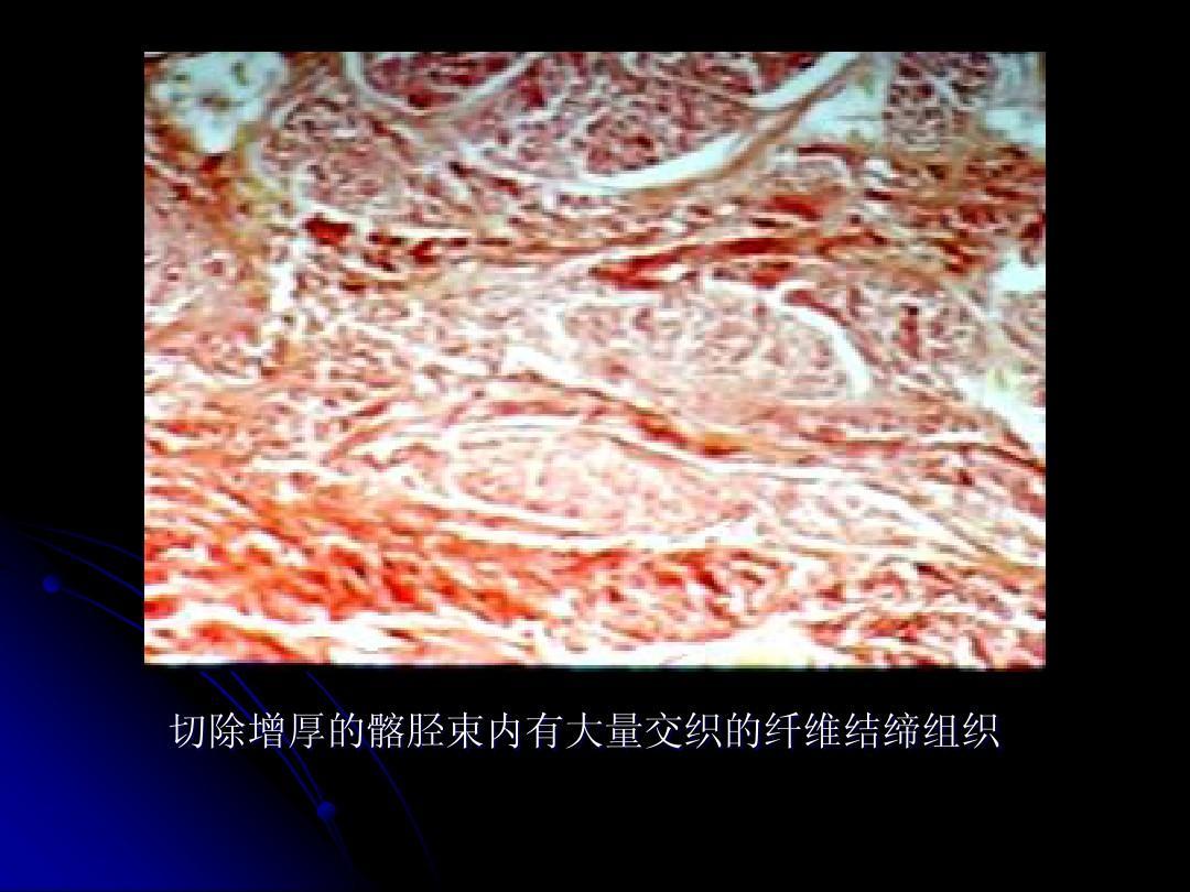 先天性髋脱位治疗方法,先天性髋关节挛缩