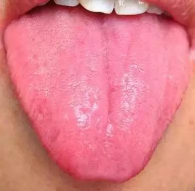 舌头中间有裂纹边有齿痕怎么回事,舌头中间有裂纹边缘锯齿怎么回事